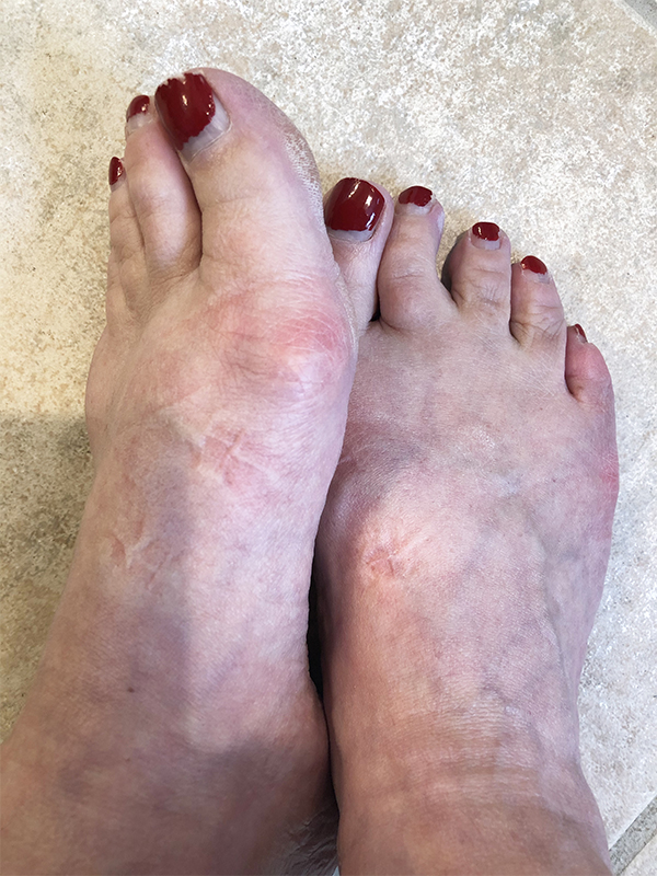 Ugly winter feet before a pedicure
