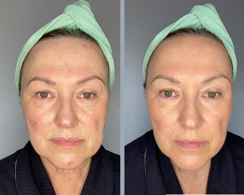 before and after foundation