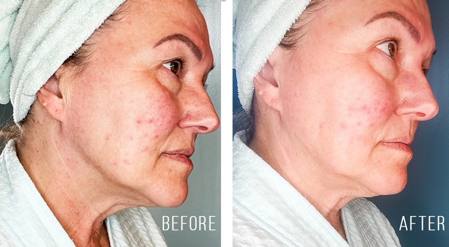 red light therapy at home