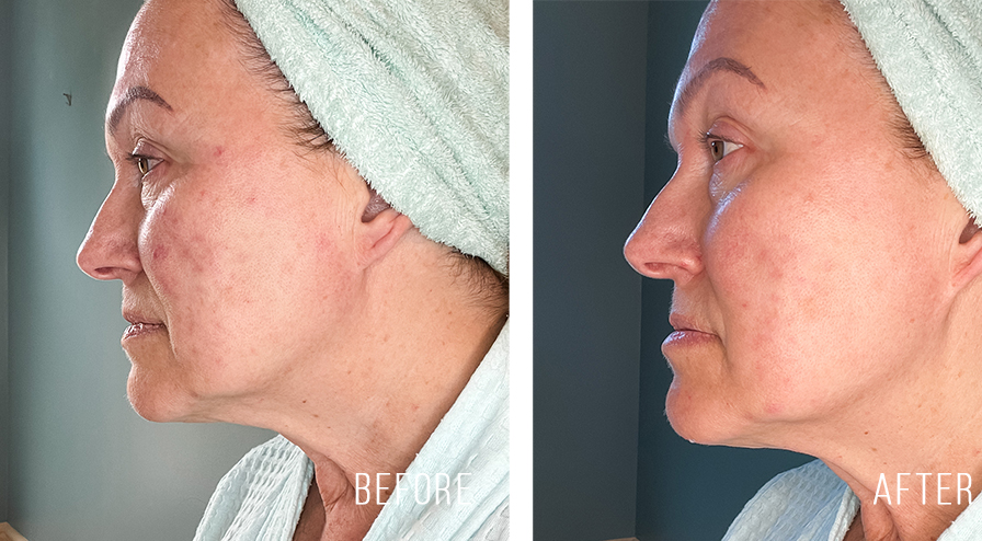 currentbody LED light therapy. mask